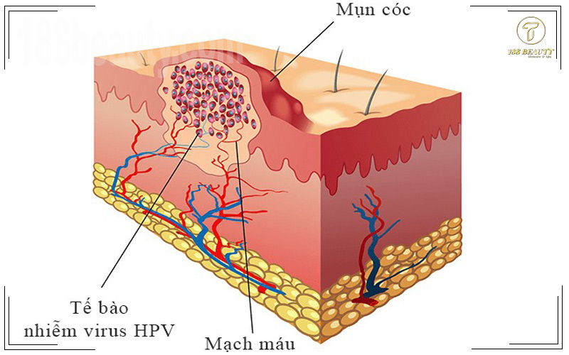 tế bào hiễm virus HPV gây ra mụn cóc